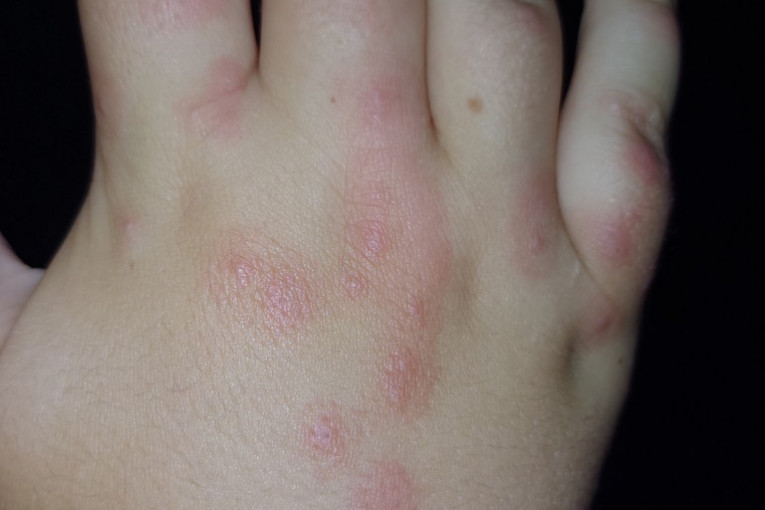 Decu u hotelu na Ohridu unakazile stenice