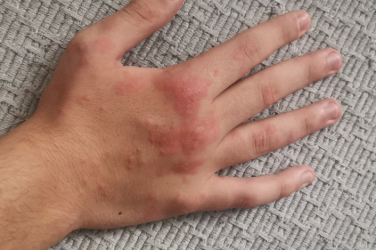 Decu u hotelu na Ohridu unakazile stenice