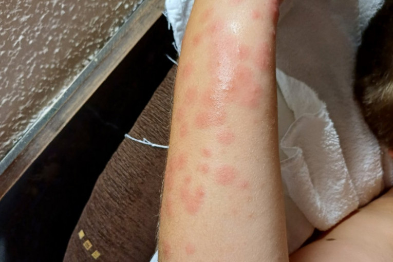 Decu u hotelu na Ohridu unakazile stenice