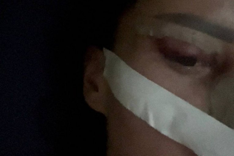 Slađa Lazić nakon operacije pokazala zavoje i podlive