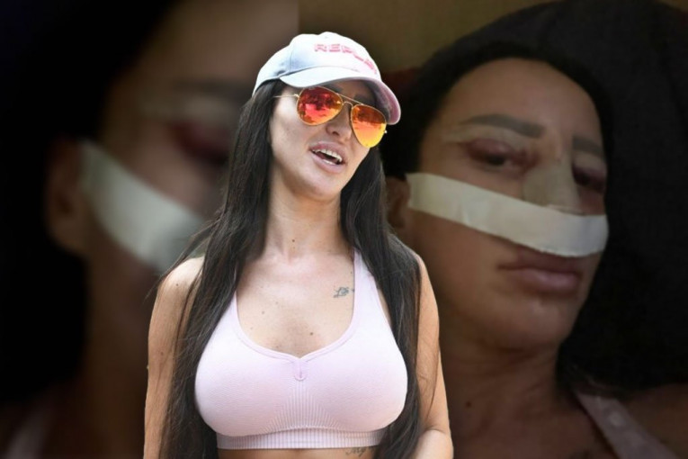 Slađa Lazić nakon operacije pokazala zavoje i podlive