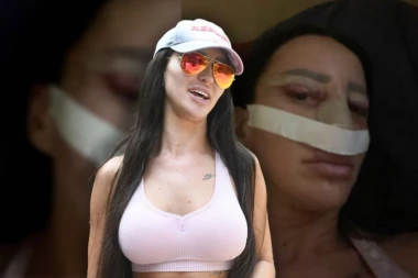 UZNEMIRUJUĆE FOTKE SLAĐE PORŠELINE NAKON OPERACIJE LICA! Starleta sva u PODLIVIMA, ima zavoje preko CELE GLAVE (FOTO)