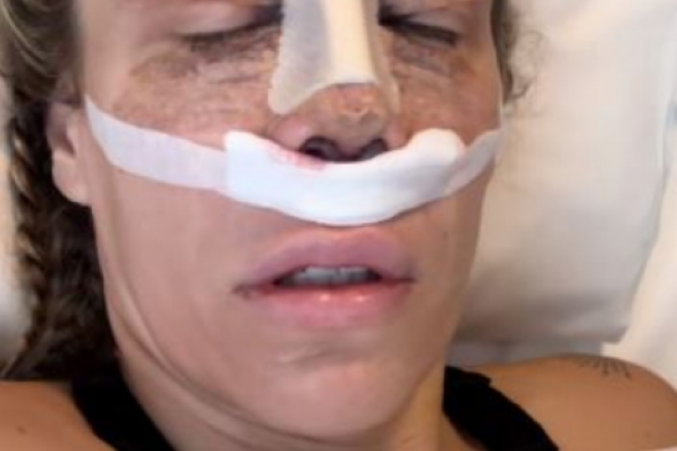 Njezvanova operacija nosa