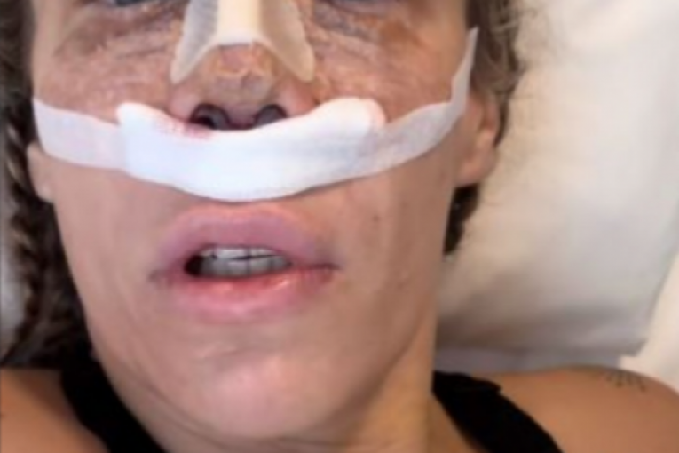 Njezvanova operacija nosa