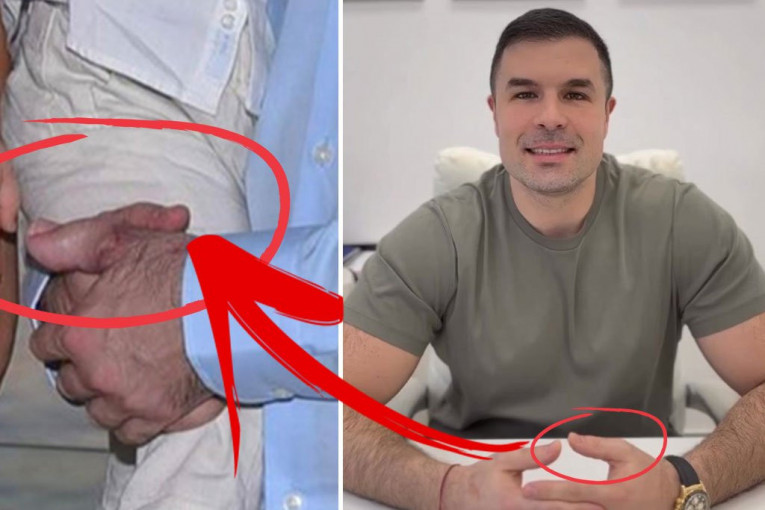 Povrede na ruci hirurga