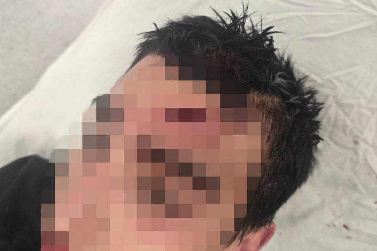 Povrede koje je zadobio pretučeni dečak!