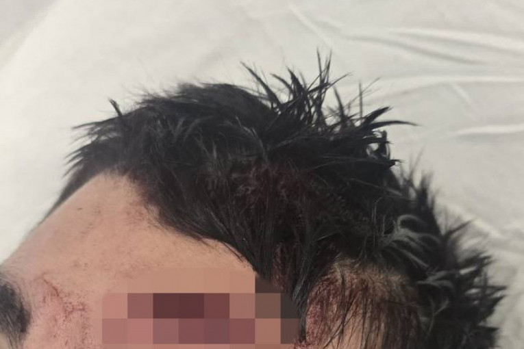 Povrede koje je zadobio pretučeni dečak!