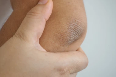 DOBRO SE ZAGLEDAJTE - ova promena na laktu ukazuje na zapaljensko oboljenje: Ako imate i ovaj simptom, pregled je OBAVEZAN