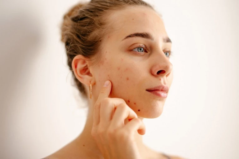 RANI ZNAKOVI DA JETRA OTKAZUJE SE PRVO VIDE NA KOŽI: Jedan iznenadni simptom vidi se oko usta, ako ga primetite, odmah kod lekara