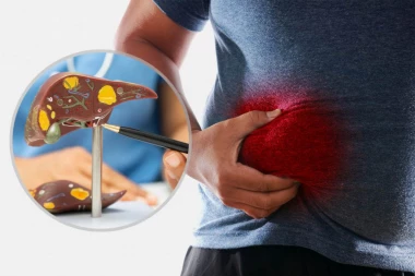 OVAJ SIMPTOM MASNE JETRE VIDI SE I BEZ PREGLEDA: Opasno je ignorisati ga - iznenadni znak vidi se na GLAVI!