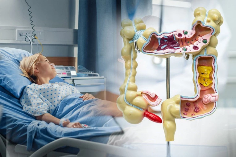 ŽALILA SE NA BOL U STOMAKU I MUČNINU, LEKARI MISLILI DA IMA UPALU SLEPOG CREVA: Hirurzi se zgrozili kad su videli šta se KRILO u njenom abdomenu