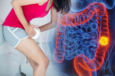 OVA PROMENA U STOLICI MOŽE DA BUDE PRVI ZNAK RAKA DEBELOG CREVA: Nije samo krv zabrinjavajuća, i ovo je ALARM