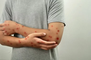 PET OSOBA HITNO HOSPITALIZOVANO! Sumnja se da imaju majmunske boginje!