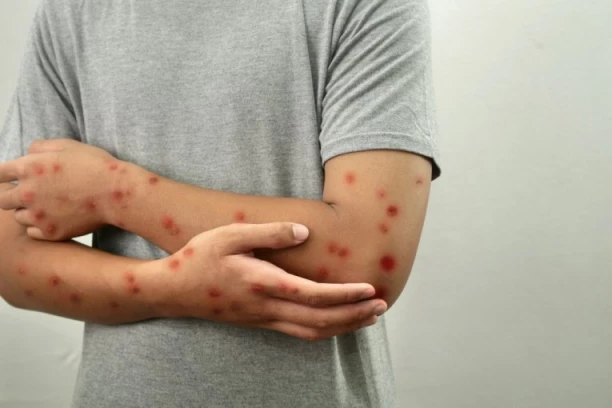 PET OSOBA HITNO HOSPITALIZOVANO! Sumnja se da imaju majmunske boginje!