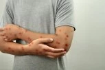 PET OSOBA HITNO HOSPITALIZOVANO! Sumnja se da imaju majmunske boginje!