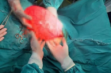 DEVOJČICI (15) UKLONILI TUMORSKU MASU TEŠKU ČETIRI KOLIGRAMA! Istorijski poduhvat valjevskih hirurga!