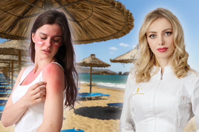 DA LI KISELO MLEKO POMAŽE KOD OPEKOTINA OD SUNCA: Dr Vojvodić objasnila kad možete da koristite prirodne preparate, a kad morate kod lekara!