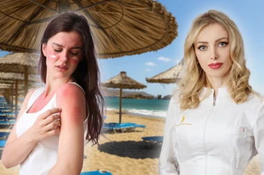 DA LI KISELO MLEKO POMAŽE KOD OPEKOTINA OD SUNCA: Dr Vojvodić objasnila kad možete da koristite prirodne preparate, a kad morate kod lekara!