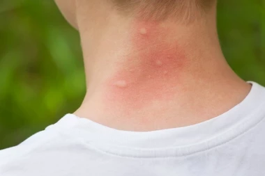 DOMOVI ZDRAVLJA PUNI LJUDI: Najezda opasnih insekata u Srbiji uzima danak