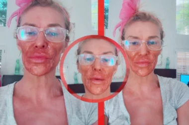 UZNEMIRUJUĆE STANJE RIJALITI-ZVEZDE: Lice joj UNAKAŽENO, a tek da vidite šta joj ŽIVI na telu! (VIDEO)