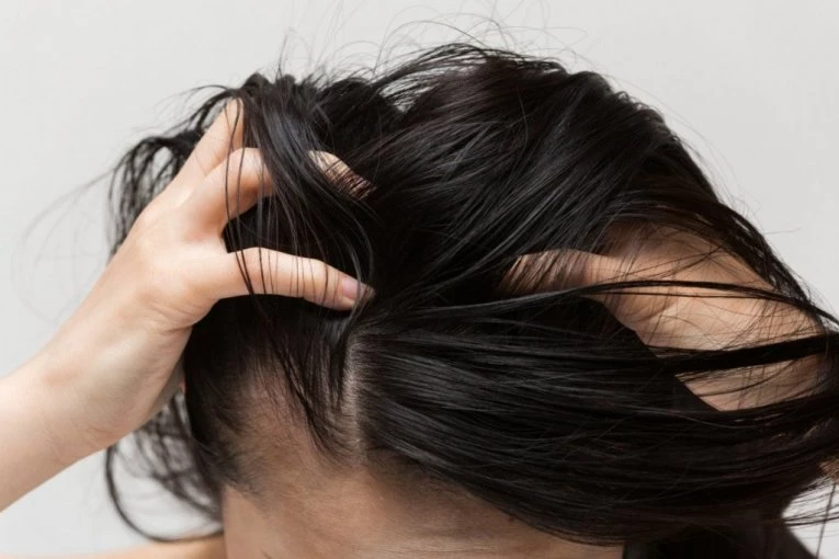 Zašto nas SVRBI TEME i kako da ga smirimo: Stručnjaci otkrivaju najčešće uzroke problema sa kožom glave