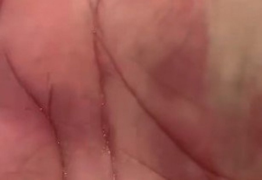 GROZNO! POJAVILI MU SE MODRI PEČATI PO TELU! Uznemirujuć snimak Asmina Durdžića! (FOTO)