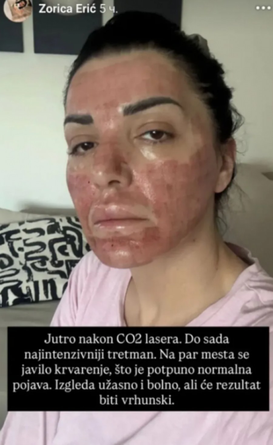 UNAKAŽENO LICE NAŠE PEVAČICE! Krenulo i krvarenje, sve je užasno bolno - procurila šok-fotografija! (FOTO)