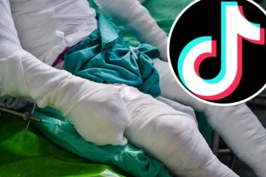 IMA TEŠKE OPEKOTINE NA 95 ODSTO TELA! Tinejdžer na ivici života zbog TikTok izazova - SLUČAJNO SE SAMOZAPALIO!