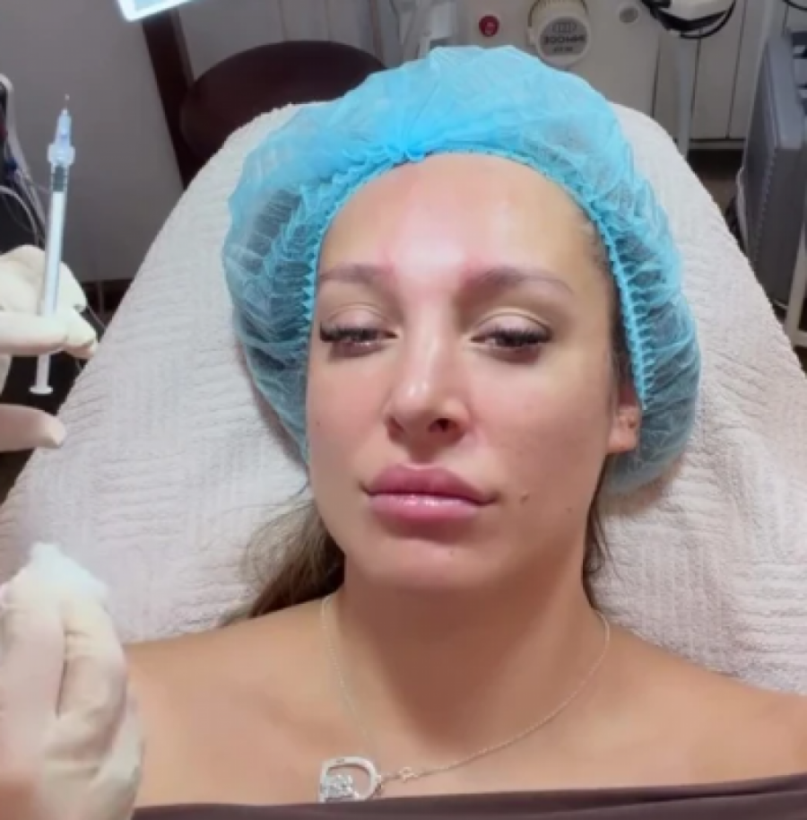 LUNA ĐOGANI UBRIZGALA BOTOKS U LICE: Evo kako sada izgleda nakon INTERVENCIJE!