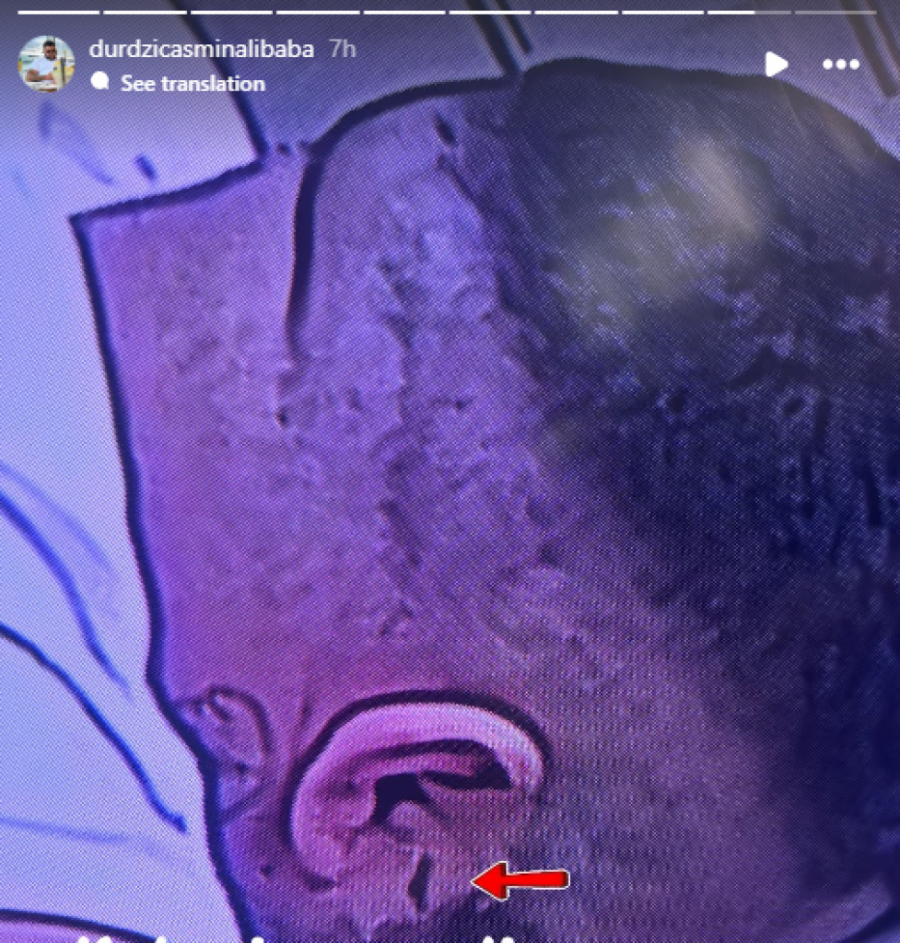 POZNATO STANJE ASMINA POSLE TUČE S MAJOM! Deformisano uho i polomljen zub zgrozili ukućane! (UZNEMIRUJUĆE FOTKE)