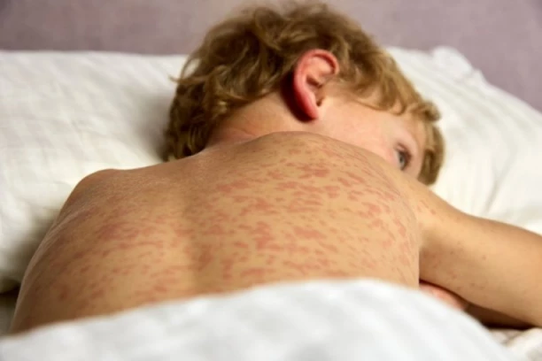 VIRUS SE ŠIRI KOD GRANICE SA SRBIJOM: Zbog antivakserskog lobija više od 500 SLUČAJEVA ZARAZE
