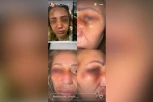 UZNEMIRUJUĆE! PRETUČENA NAŠA INFLUENSERKA! Prijateljica Darka Lazić prijavila slučaj policiji!