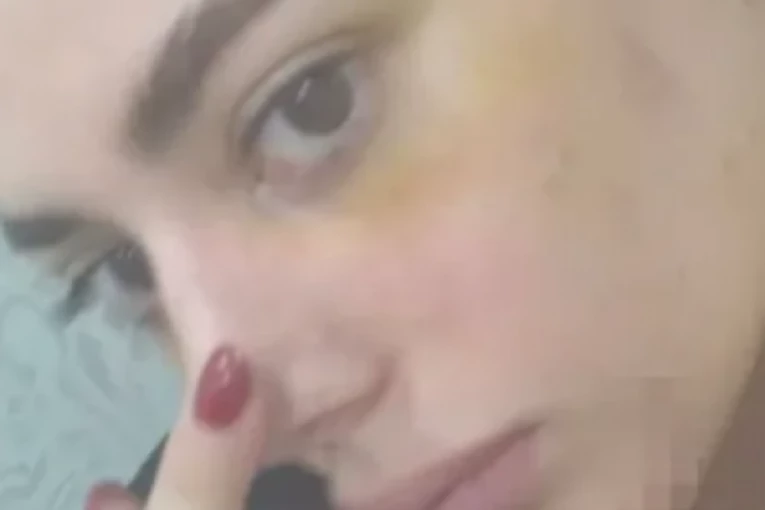 PRVE SLIKE PRETUČENE BIVŠE ZADRUGARKE: Lice joj je UNAKAŽENO od batina, KRV joj ŠIKLJA, hitno se oglasila i otkrila sve!