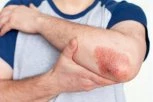 Imate psorijazu? Biološka terapija dostupna je o trošku države, ali morate da ispunite ove uslove